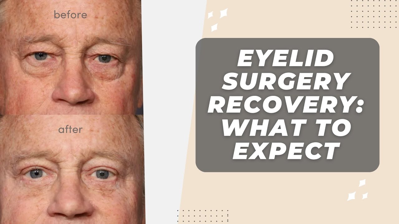 Eyelid Surgery Recovery: Plastic Surgeon Explains What To Expect