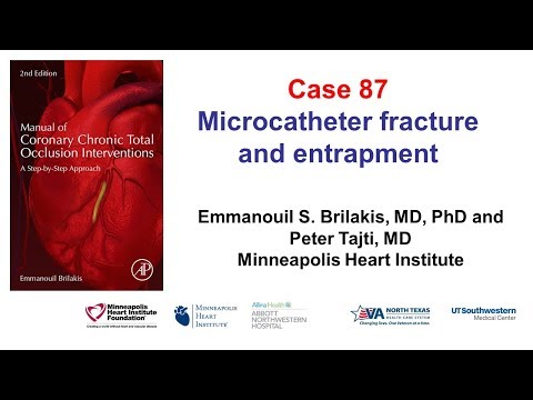 Case 87: Manual of CTO interventions: Microcatheter fracture and entrapment