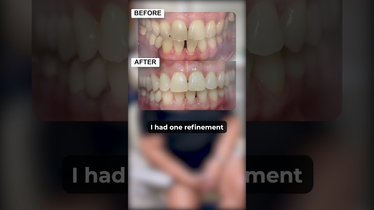 Veronica's Smile Transformation