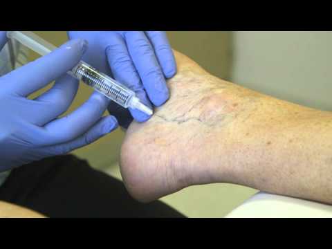 Spider Vein Treatment - Sclero Therapy