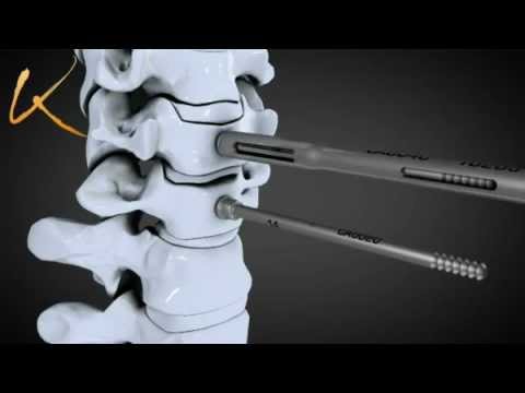 comment traiter arthrose cervicale