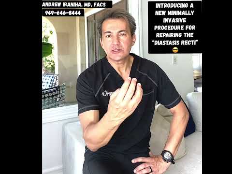 Dr  Iraniha New Minimally Invasive Procedure to Repair Diastasis Recti