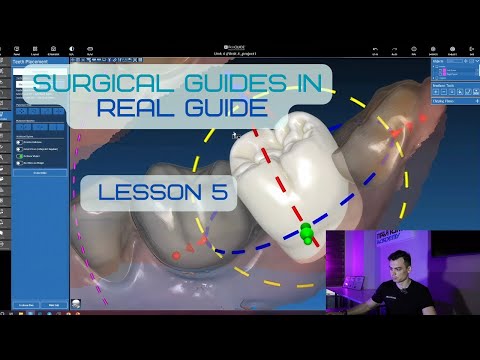 Surgical guides in RealGuide Tutorial. Lesson 5. CT and scans alignment, Waxup setup