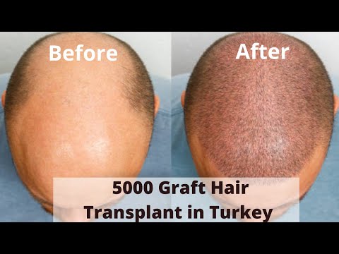 5000 Graft Hair Transplant in Turkey | 5000 Grafts...