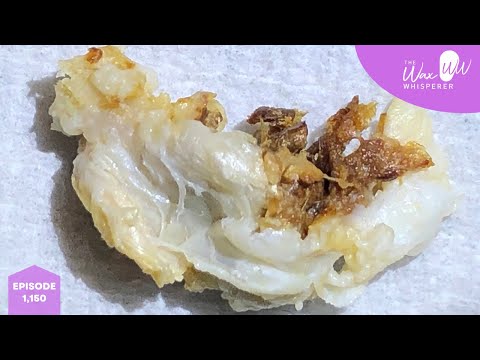 1,150 - Complex Grade III Keratosis Obturans Removal