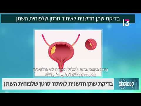 בדיקת שתן חדשנית לאיתור סרטן שלפוחית השתן