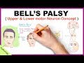 Bell's Palsy Vs Stroke Eyebrow