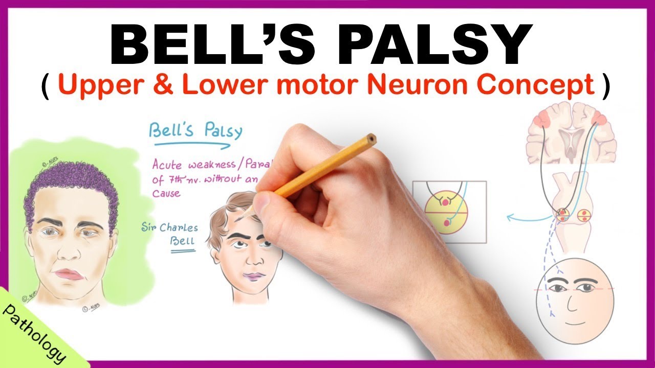 Bell's palsy Upper and Lower Motor Neuron Lesions - Simplified