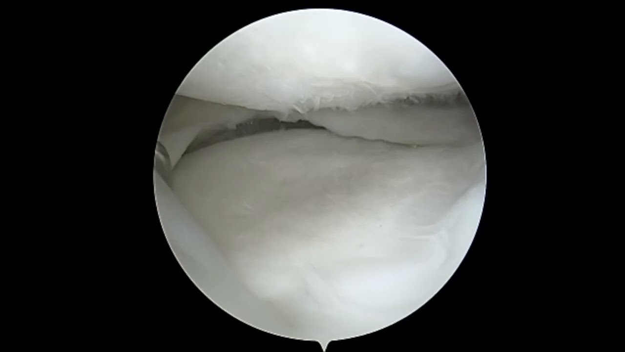 2nd look after lateral dovetail meniscus transplant