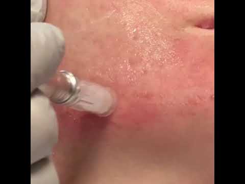 Acne Scar Treatment - Skin Needling