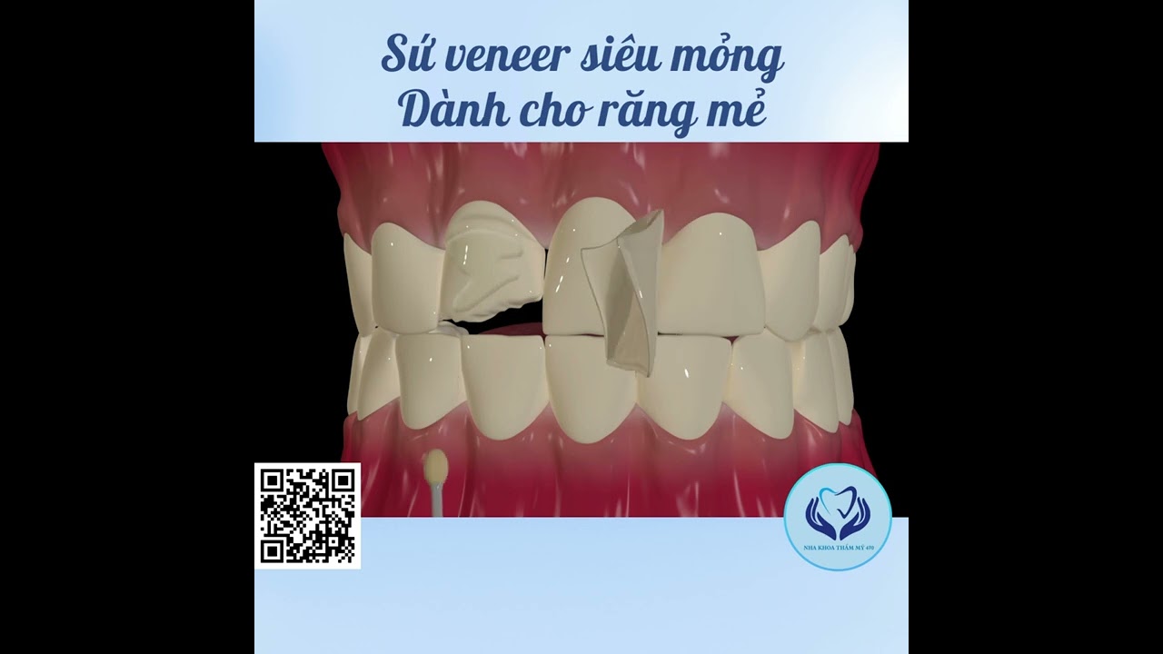 Mặt dán sứ trông ra sao? Nha khoa uy tín quận 3