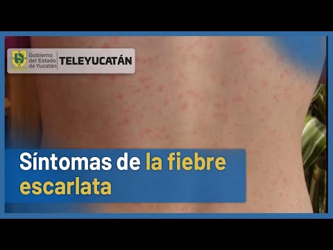 ¿Habías escuchado hablar de la fiebre escarlata o escarlatina? | AQUÍ LOS SÍNTOMAS | TELE Yucatán