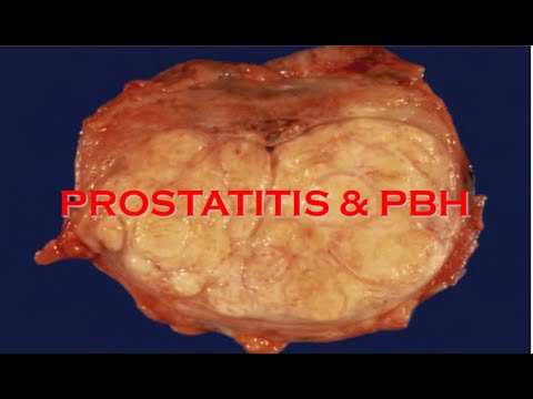 Kalcinál és prosztatitis