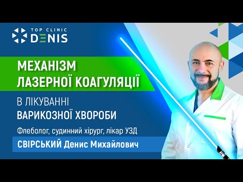 Механизм лазерной коагуляции в лечении варикозной болезни