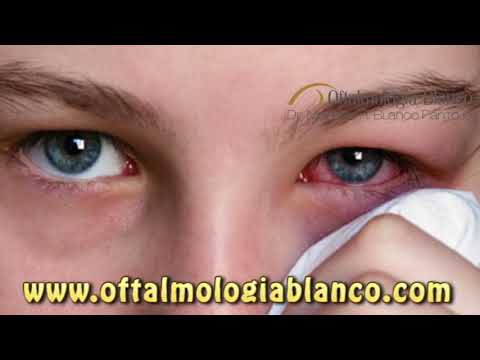 Conjuntivitis Viral