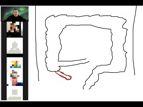 Pediatric surgery lesson 1;  Acute appendicitis