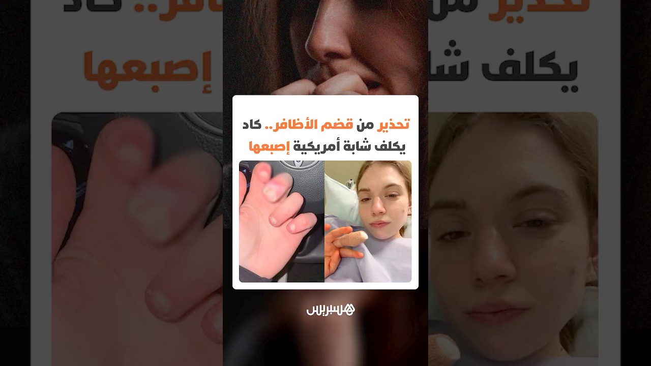 تحذير من عادة قضم الأظافر.. كاد يكلف شابة أمريكية إصبعها thumbnail