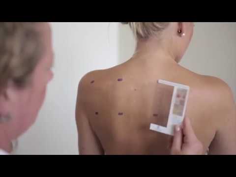 skin patch test hong kong,  patch test allergens, allergen patch test