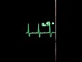 3 Derece Av Tam Blok EKG Ritmi