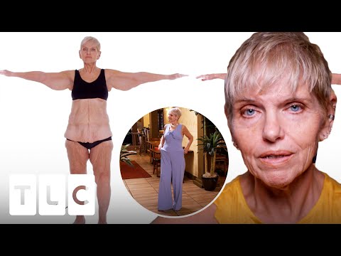 Beautiful Transformation - Woman Loses 7 Pounds of Excess Skin! | My Extreme Excess Skin