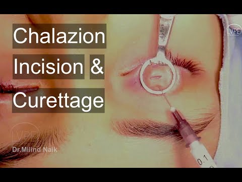 Modul în care chalazionul afectează vederea, Salazionul (Chalazionul)