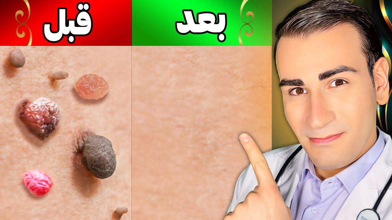 از بین بردن یک روزه زگیل و منگوله های پوستی در خانه | Removing Warts and Skin Tags