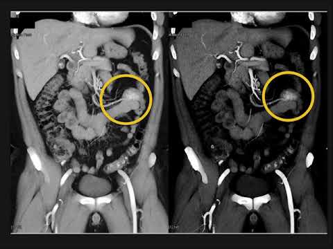 CTA of Small Bowel Obstruction: Some New Thoughts and Concepts Part 1