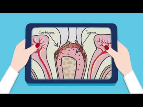 Qu'est-ce que la gingivite et la parodontite ?