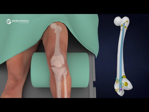 Mastering the RFN Retrograde Femoral Nailing System | Surgical Technique Animation