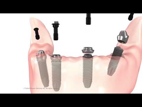 All-on-4 metoda inozemni pacijenti - Stomatološka poliklinika | All-on-4 metoda u Hrvatskoj | Stomatološka poliklinika Zagreb | Štimac centar dentalne medicine