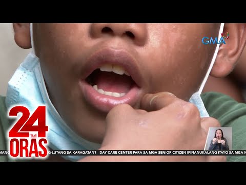 72% ng mga Pinoy, may bulok na ngipin ayon sa PHL Dental Assoc. 24 Oras
