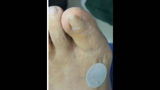 Ep_8470 Foot nails skin removal 👣 คนเป็นไม่ได้ดู..คนดูไม่ได้เป็น 😄 (clip from Thailand)