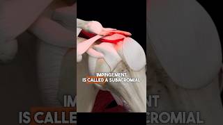 Surgery for Shoulder Impingement? What Research Says.