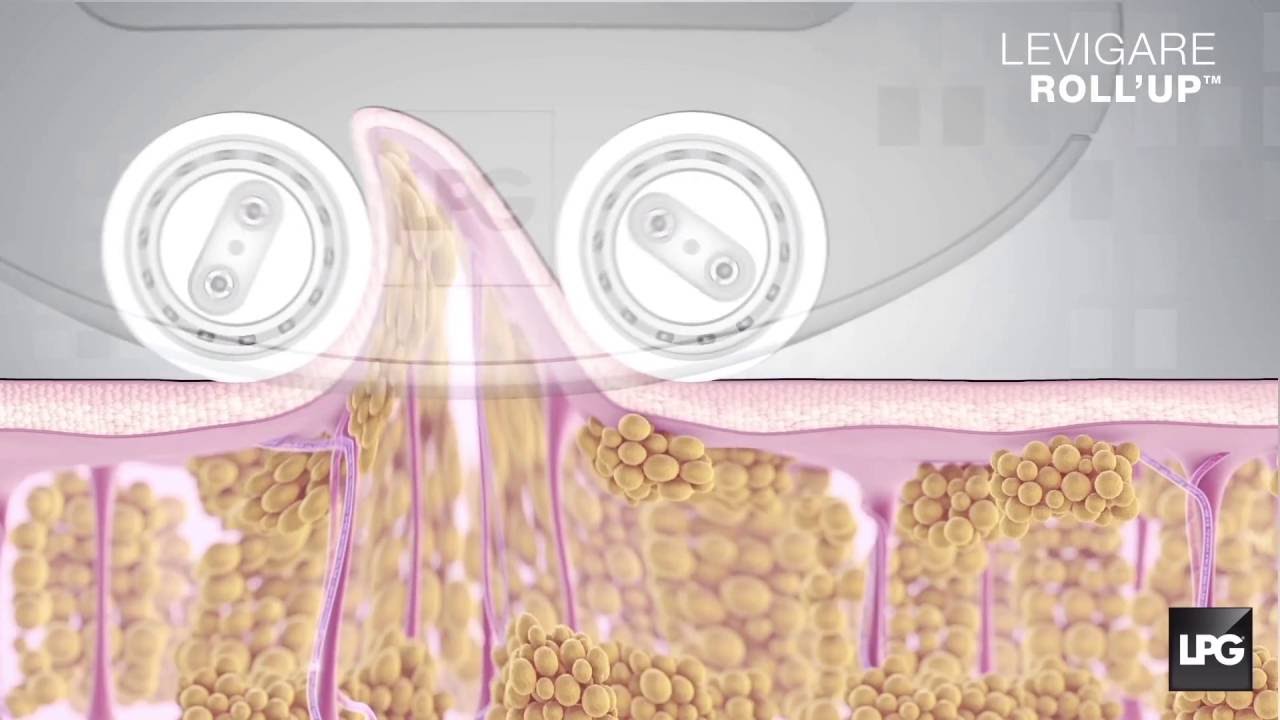 LPG NEW LIPOMASSAGE