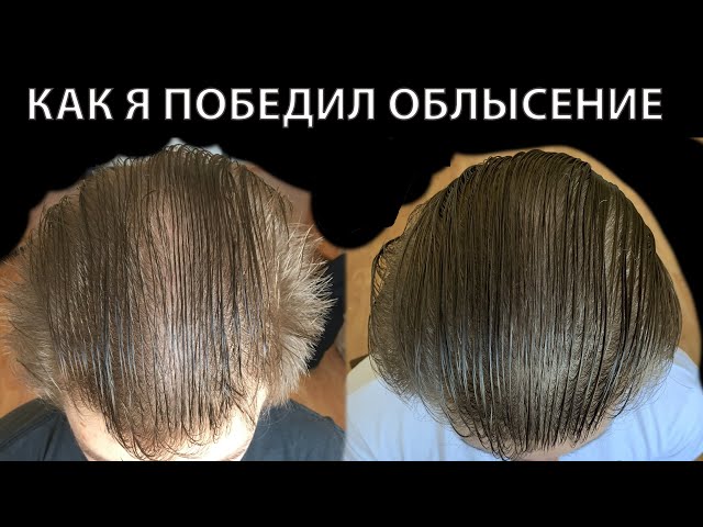 Выпадают Волосы На Ногах Почему