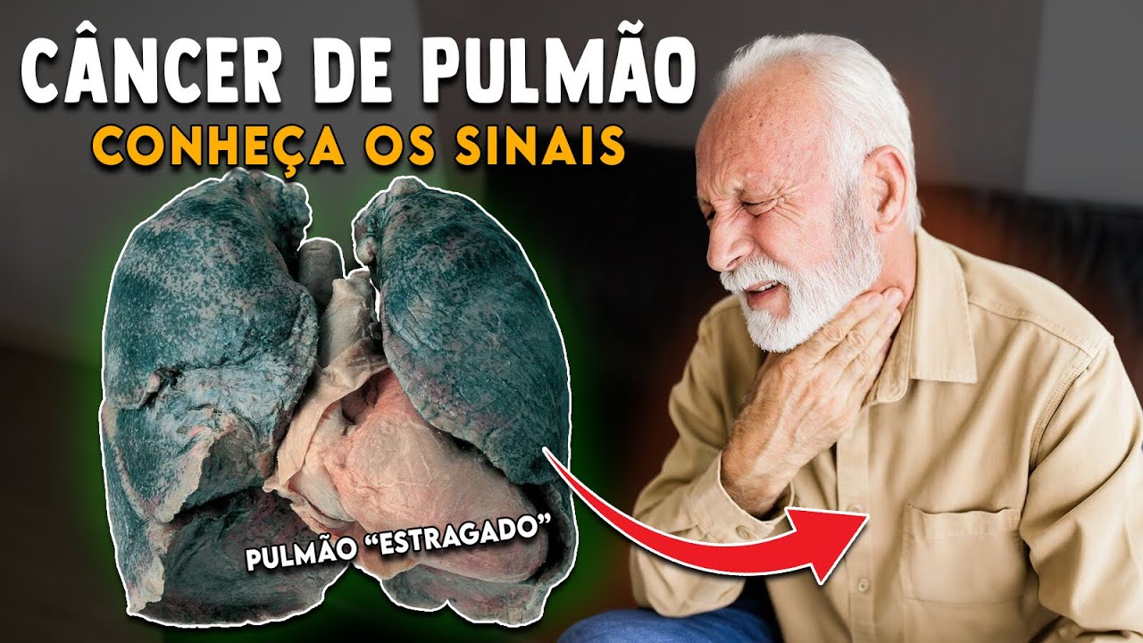 10 Sinais ou Sintomas do Câncer de Pulmão