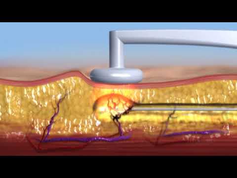 ¿Cómo funciona BODYTITE?