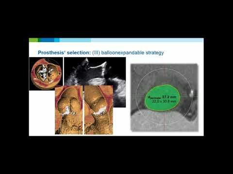 15.30-15.40: TAVR in Bicuspid Valves, Joerg Kempfert, MD