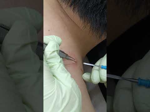 Quick & Safe Skin Tag Removal | Medical Laser Removal
