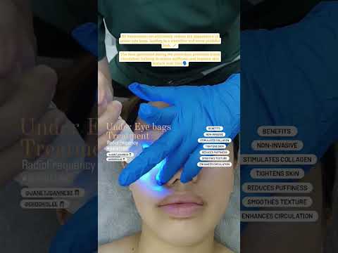 Say Goodbye to Tired Eyes: Radio Frequency for Under-Eye Bags