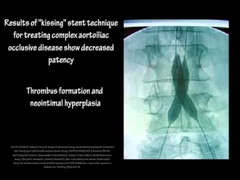 aortoiliac occlusive disease