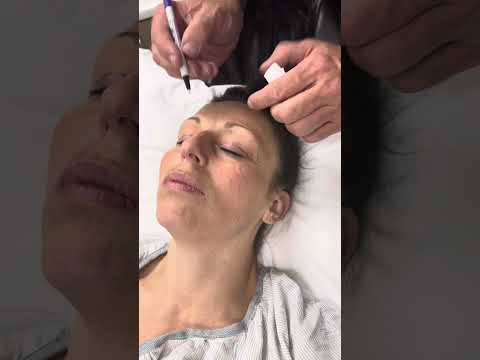 Watch Dr. Ward, the best plastic surgeon, do my eyelid incisions. So happy I had this procedure performed!