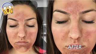 SCARY CHEMICAL PEEL EXPERIENCE