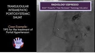 TRANSJUGULAR INTRAHEPATIC PORTOSYSTEMIC SHUNT: Case Example - TIPS, Treatment of Portal Hypertension