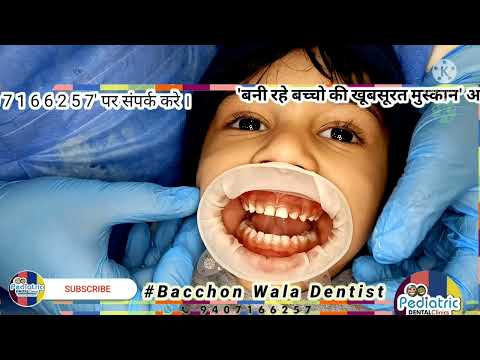 Lip tie | Open Mouth Posture | Oral Breath | Blocked Nose  are Risk factor | Early Childhood Caries