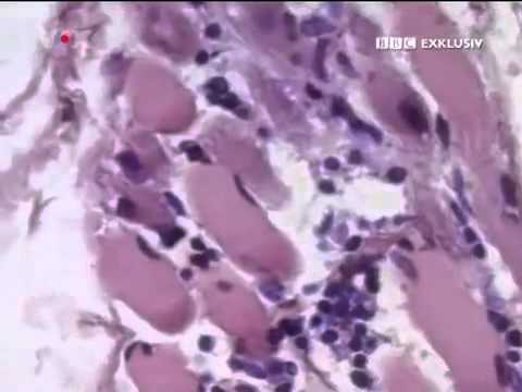 Lebendig Versteinert - BBC Exklusiv exklusiv Münchmeyer Syndrom FOP Teil 3