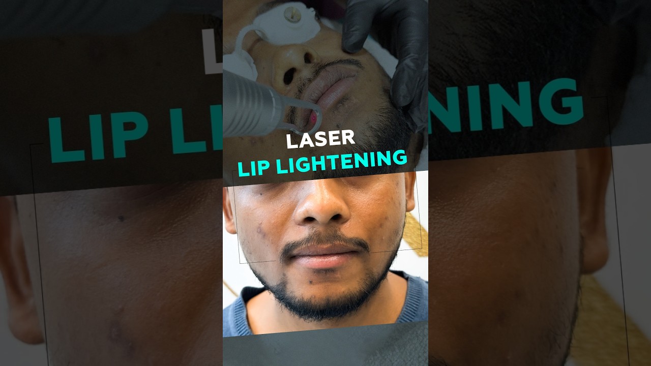 Best Laser Lip Lightening Treatment #liplightening #laserliplightening #lip #shorts