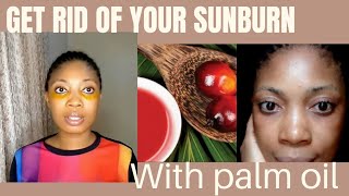 Get rid of stubborn sunburn with palm oil. home remedy