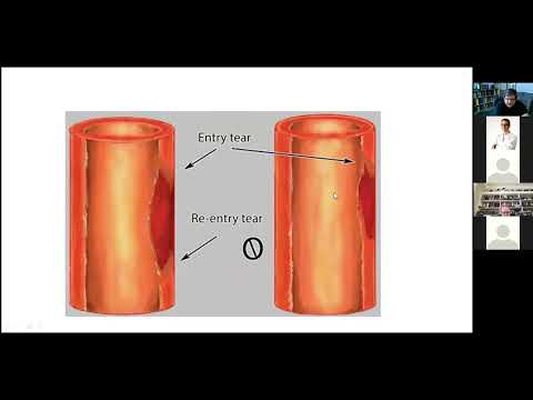 Intramural hematoma on CT scan
