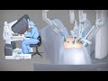 Robotic Hysterectomy For High BMI Patients TVASurg